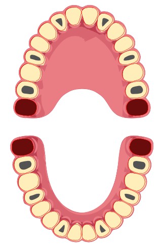 14 Elementi Dentari su 6 Impianti in Arcata Superiore. 14 Elementi Dentari su altrettanti 6 Impianti in Arcata Inferiore